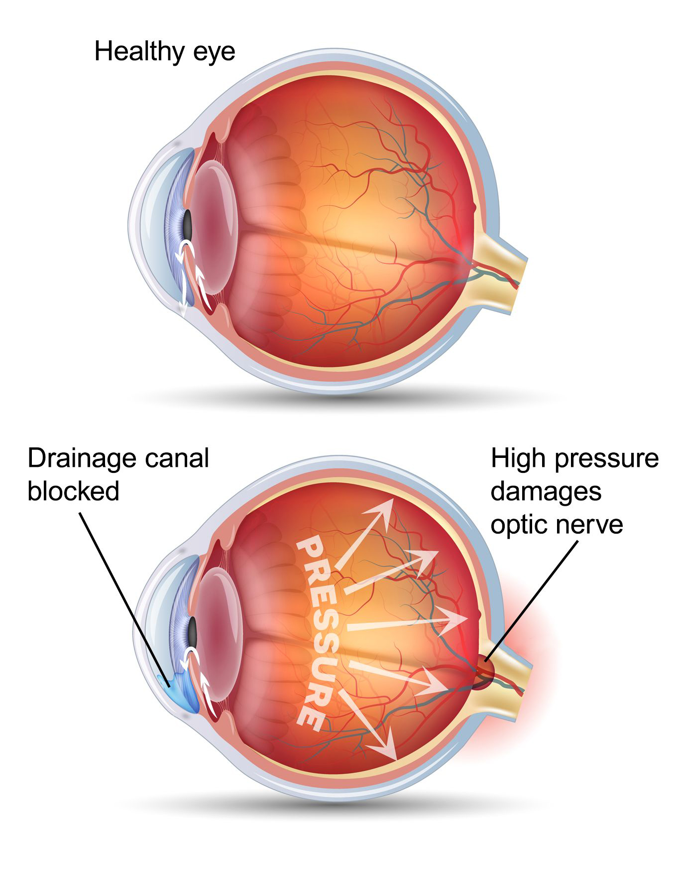 Glaucoma treatment in Ghatkopar, Mumbai