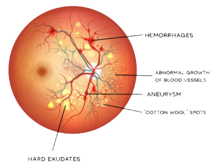 DIABETIC RETINOPATHY